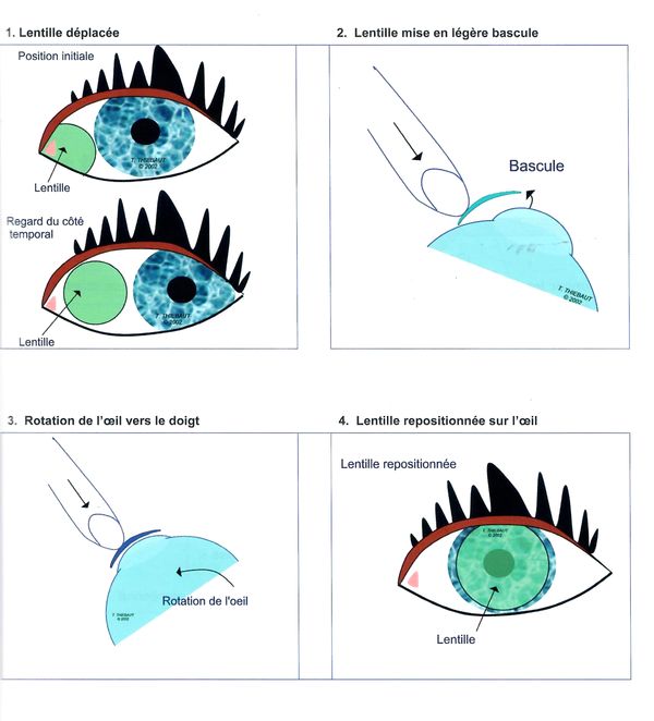 Déplacement lentilles rigides OrthoK 600