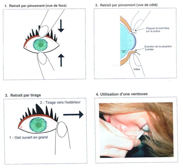 Retrait de lentilles rigides Orthok 600