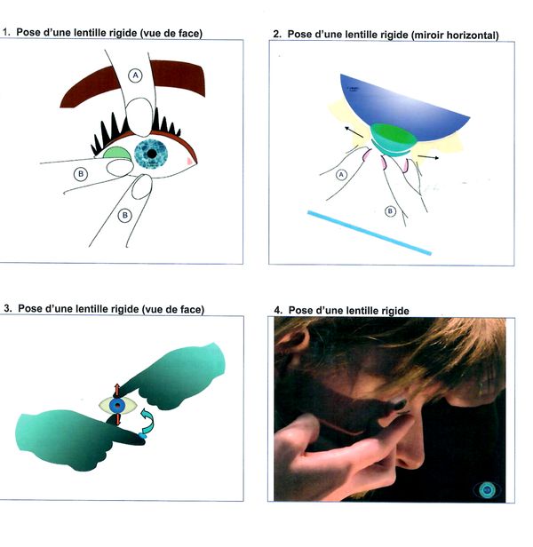 pose de lentilles rigides 600